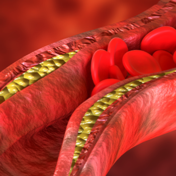 3D concept of cholesterol clogging the blood flow